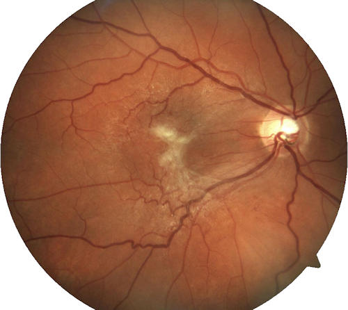 Epiretinal Membrane