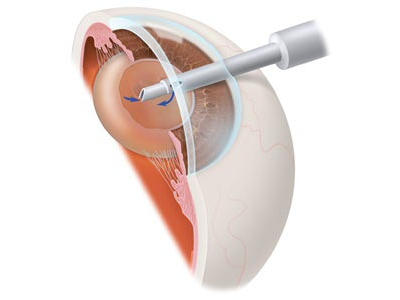 Cataract Treatment - Phaco