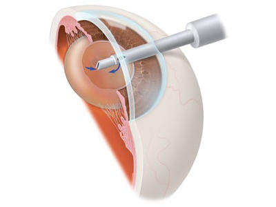 Katarakt Tedavisi - Fako