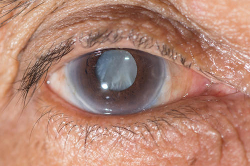 Cataract