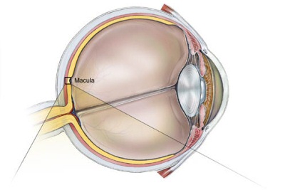 Macular Degeneration (Yellow Spot Disease)