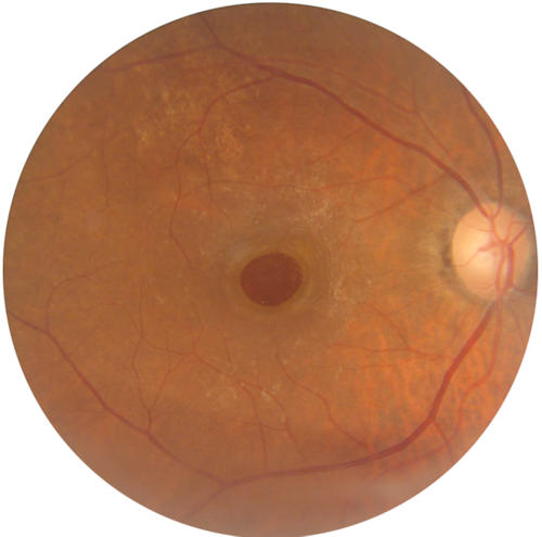 Macular Hole