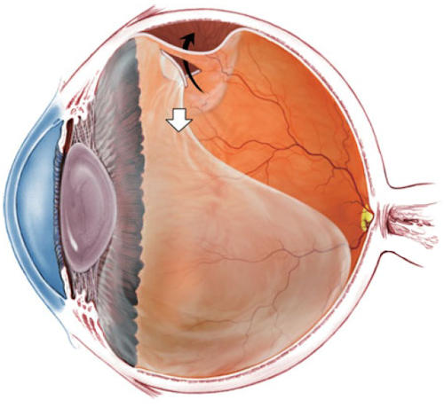 Retinal Detachment