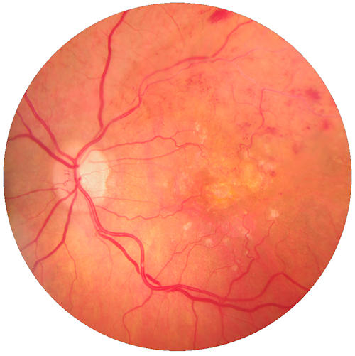 Retina Damar Tıkanıklıkları