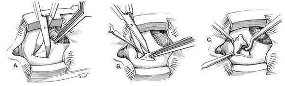 Strabismus Surgery