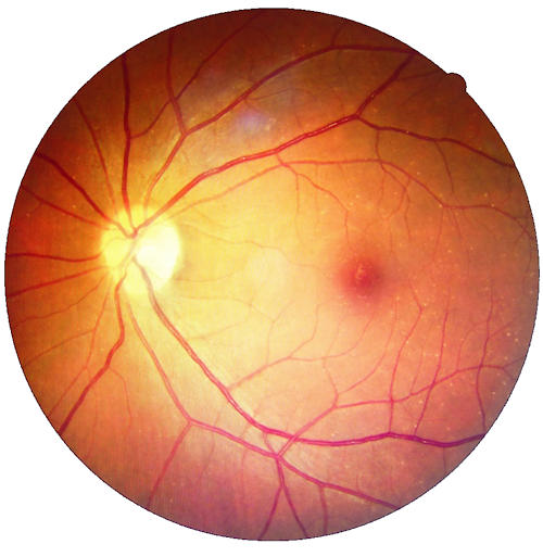 Diabetic Retinopathy