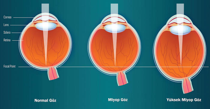 Myopia